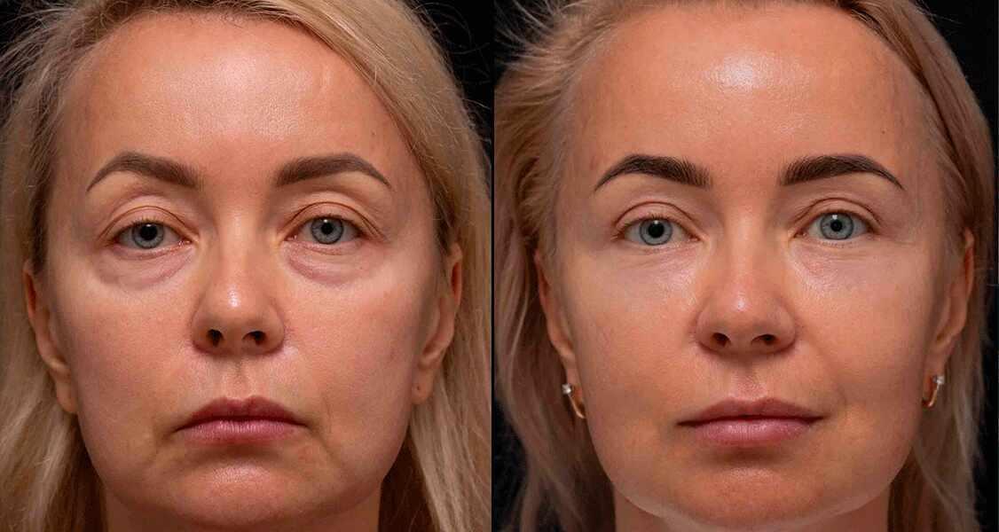 Липофилинг лица Липофилинг лица